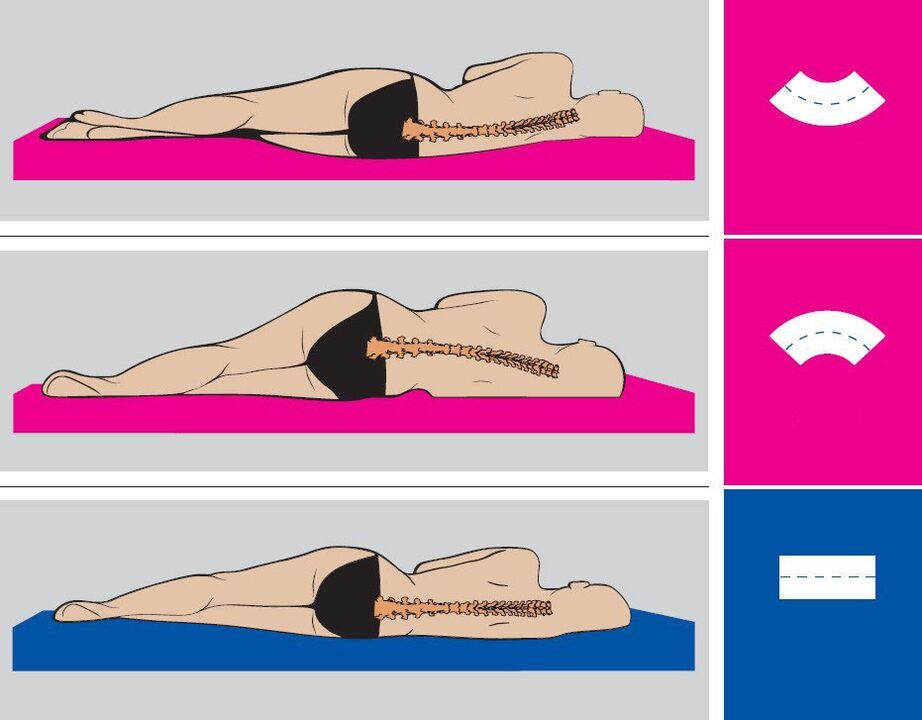 Correct body position during sleep in lumbar osteochondrosis