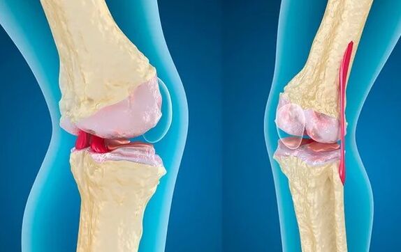Gonartlost 3. Degree knee joint