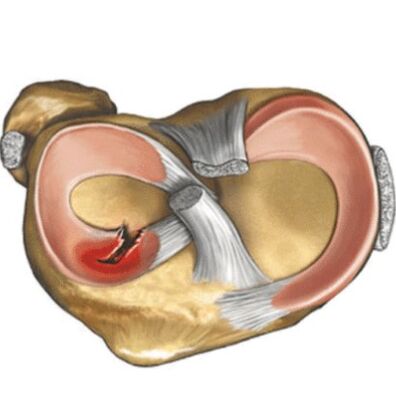 Injuries to Meninjske