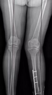 Knee deformations