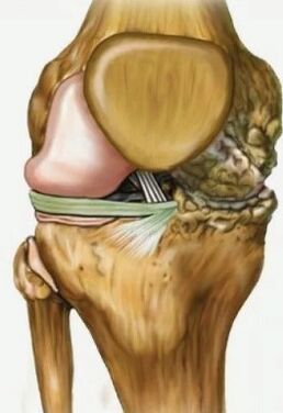 Knee wrist arthrosis