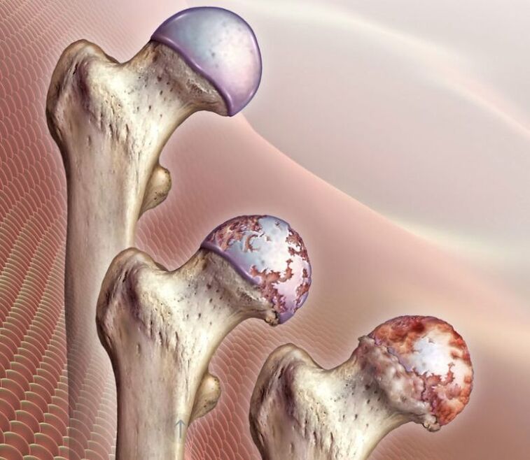 Hook's wrist arthrosis