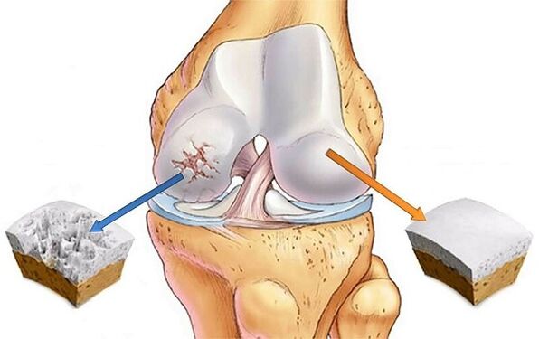 Norm and deviation for knee joint arthritis