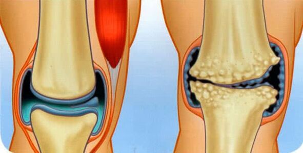 Normal state of wrist and causes of knee arthrosis development