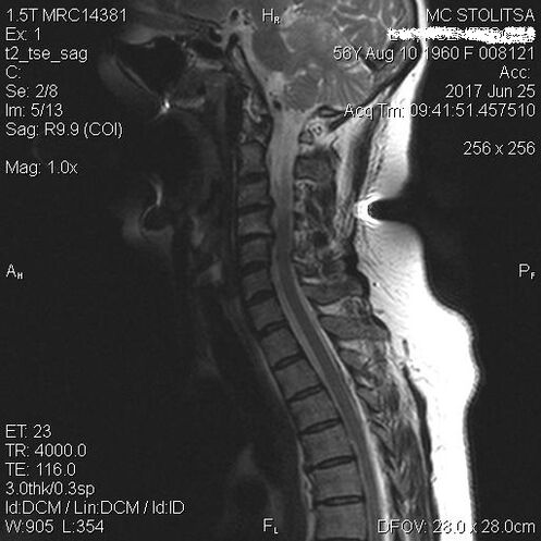 Osteochondrosis and spondylosis of the neck spine