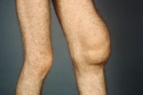 Causes and symptoms of knee joint arthrosis