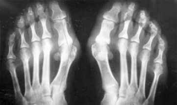 Differential diagnosis of arthritis and arthrosis symptoms