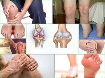 How to Prevent Arthritis and Arthrosis Development
