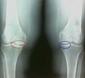 The result of the treatment of arthritis and folk drugs arthrosis