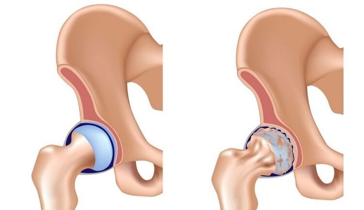 Healthy and connected with arthrosis