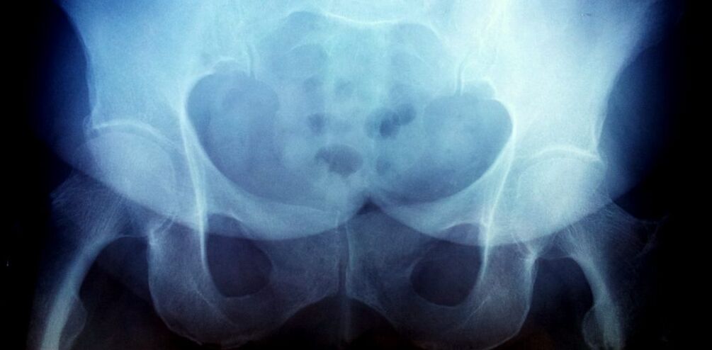 X -ray picture with the art of second degree